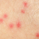 Mosquito Bites